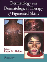DERMATOLOGY AND DERMATOLOGICAL THERAPY OF PIGMENTED SKINS